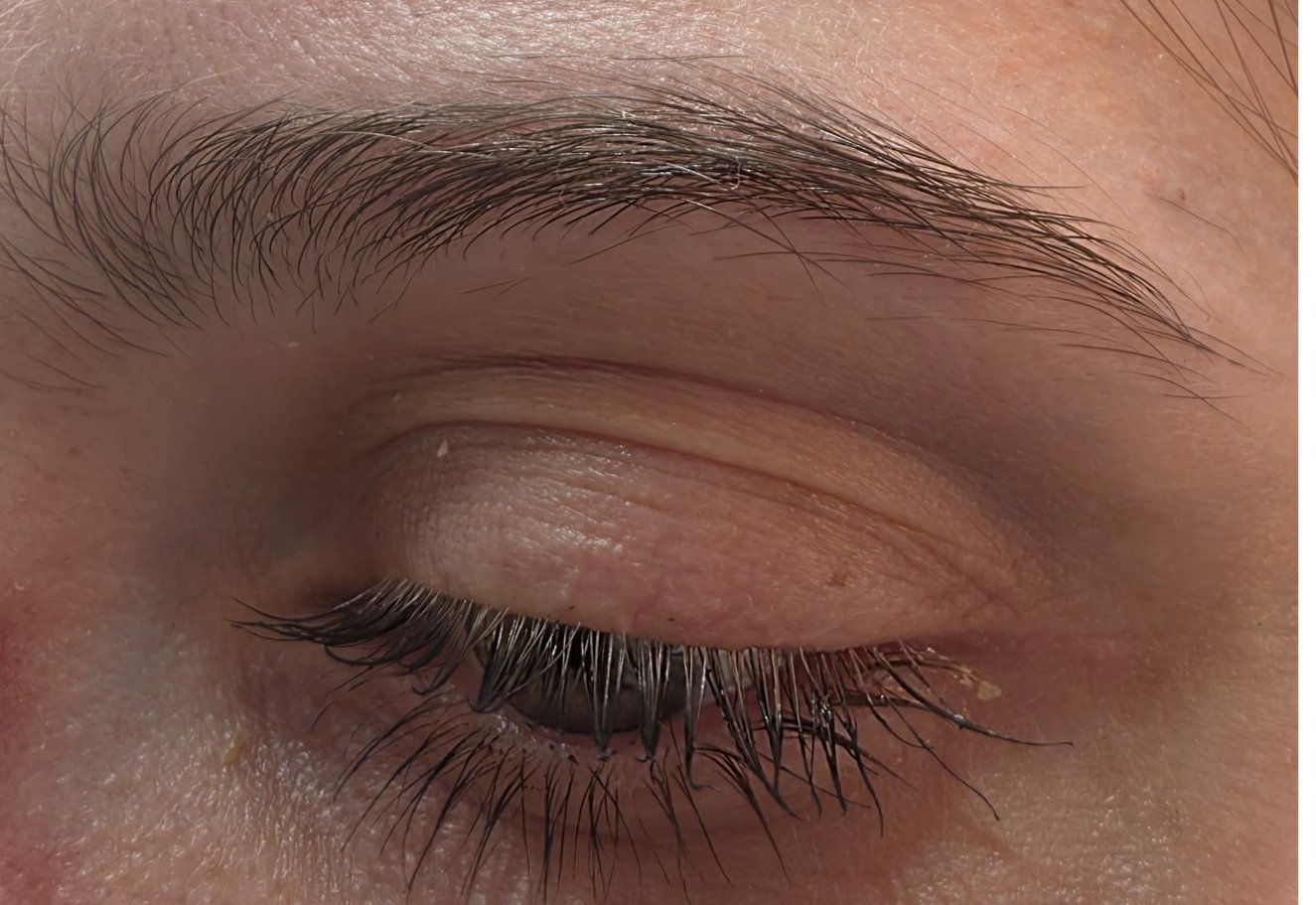 Sourcils avant browlift